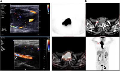 Case report: Recurrent syncope as initial symptom in a patient with neck lymphoma